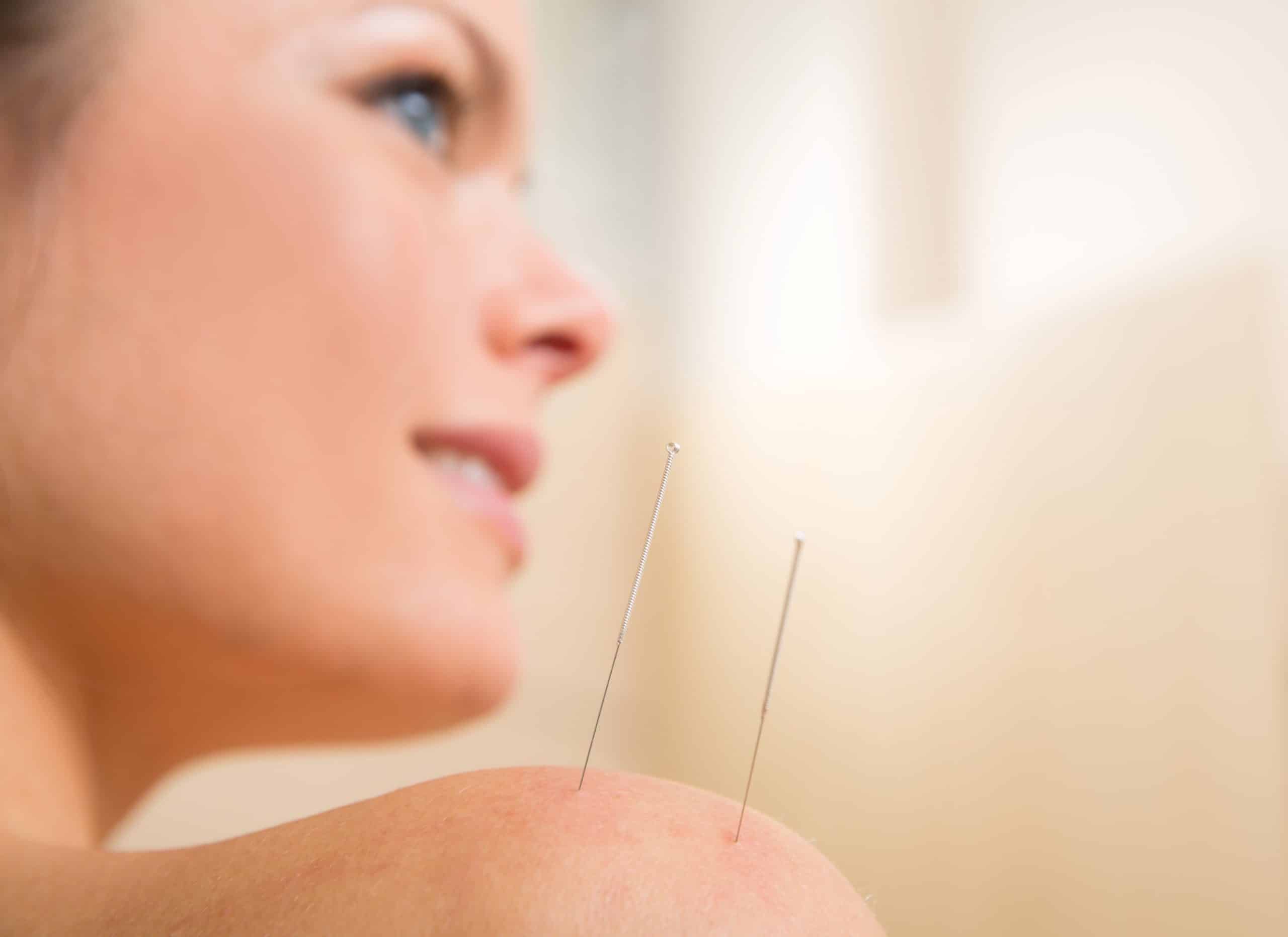How Acupuncture Can Help Combat Opioid Addiction